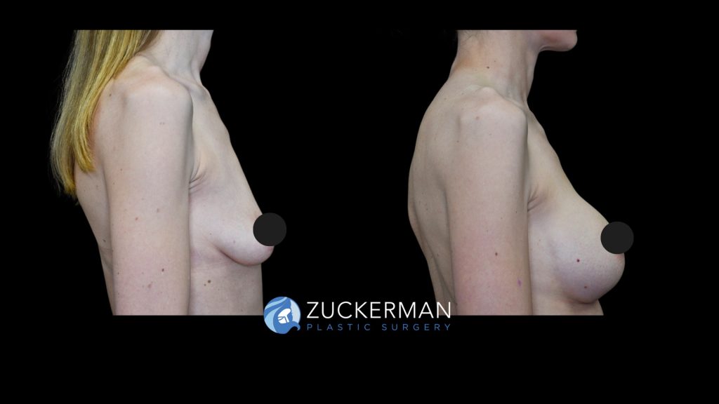 Patient before and after Breast Augmentation | Zuckerman Plastic Surgery