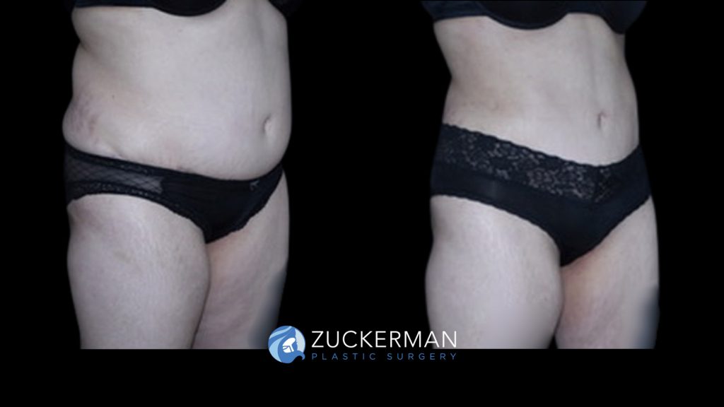 Patient before and after Liposuction & Renuvion to Abdomen, Flanks & Back | Zuckerman Plastic Surgery