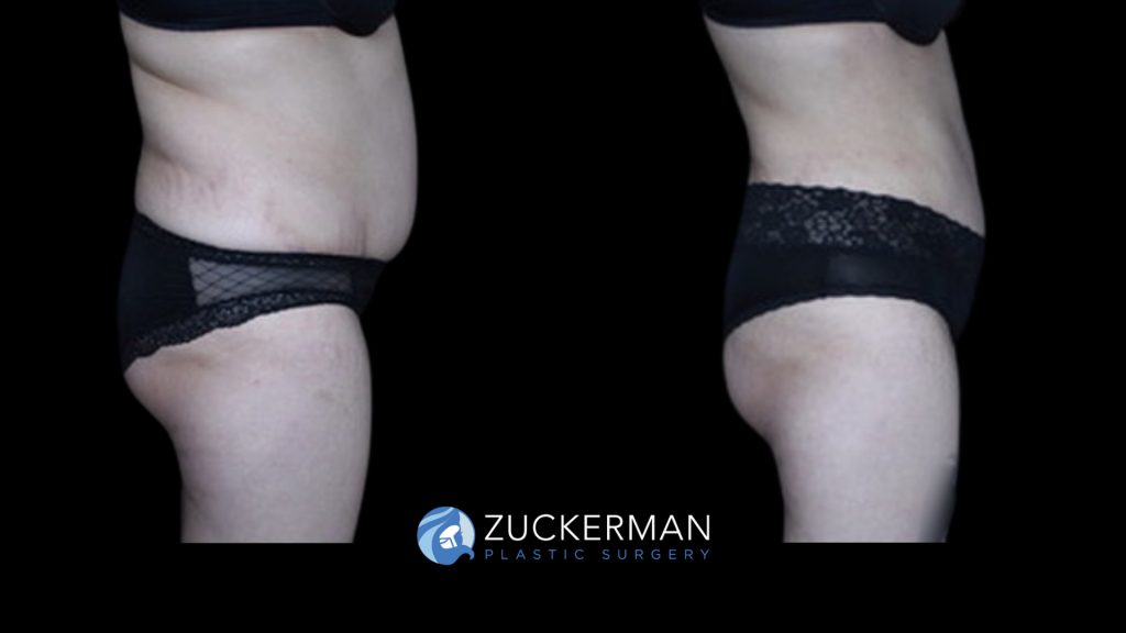 Patient before and after Liposuction & Renuvion to Abdomen, Flanks & Back | Zuckerman Plastic Surgery