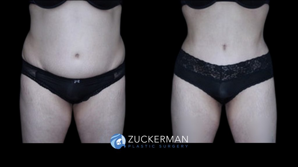 Patient before and after Liposuction & Renuvion to Abdomen, Flanks & Back | Zuckerman Plastic Surgery