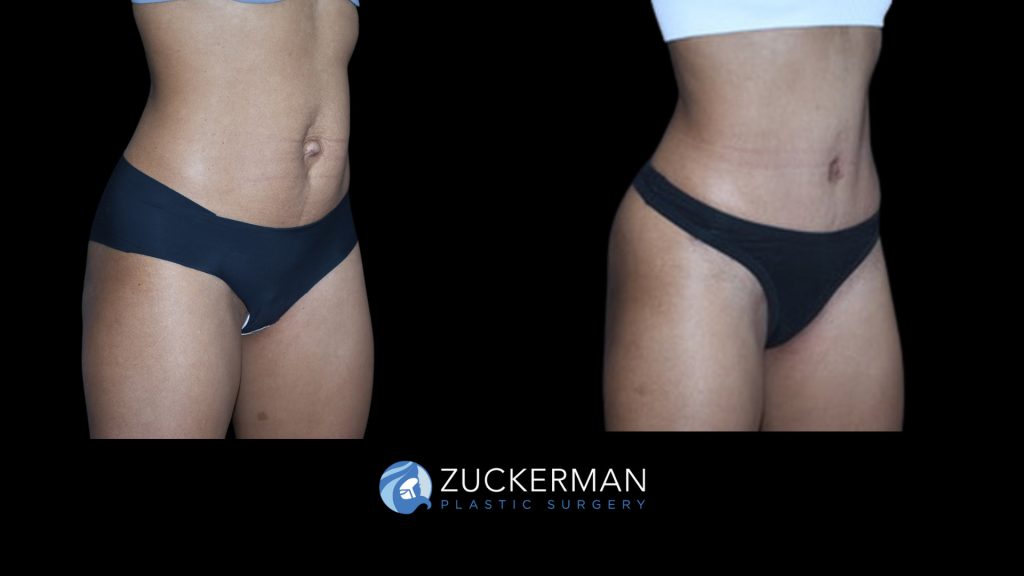 Patient before and after Tummy Tuck | Zuckerman Plastic Surgery