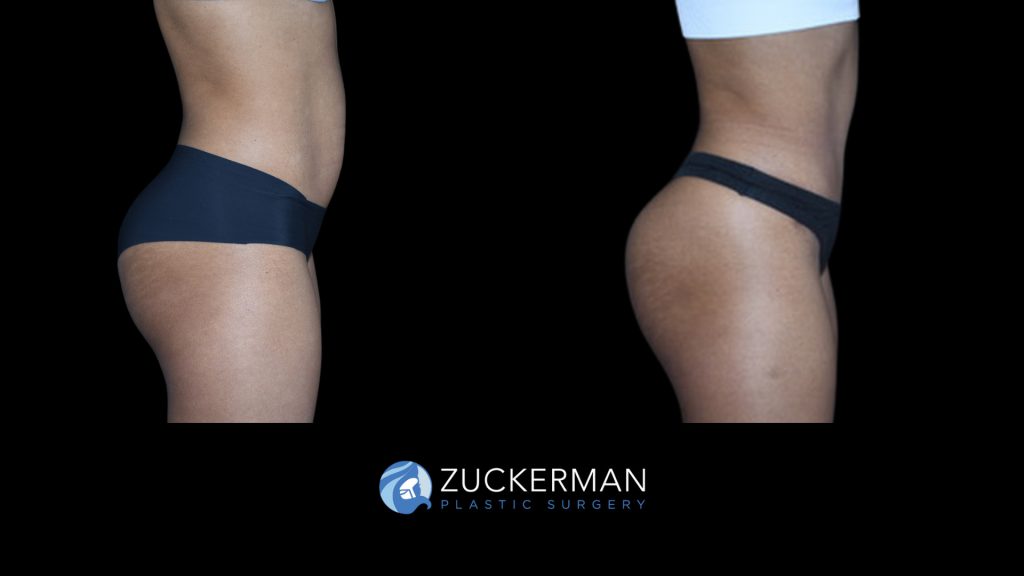 Patient before and after Tummy Tuck | Zuckerman Plastic Surgery