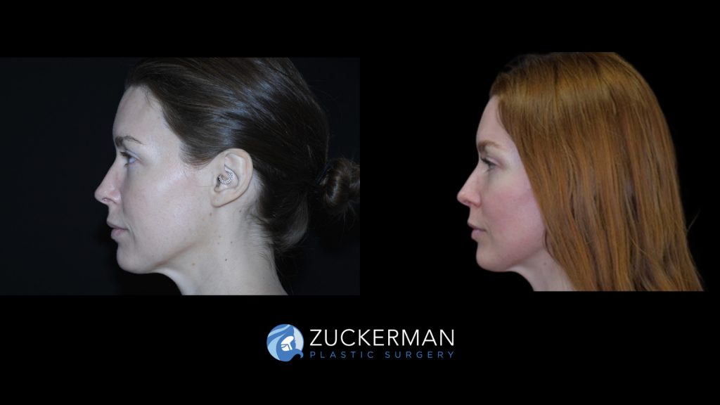 Patient before and after Blepharoplasty | Zuckerman Plastic Surgery