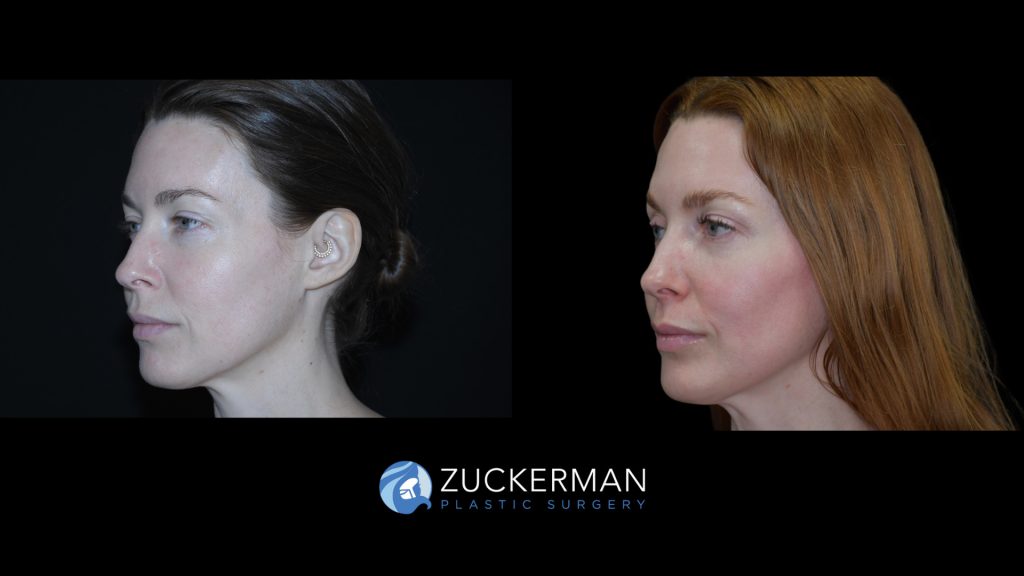 Patient before and after Blepharoplasty | Zuckerman Plastic Surgery