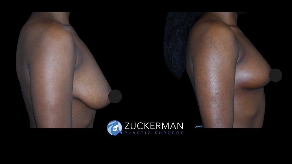 Patient before and after Breast Reduction | Zuckerman Plastic Surgery