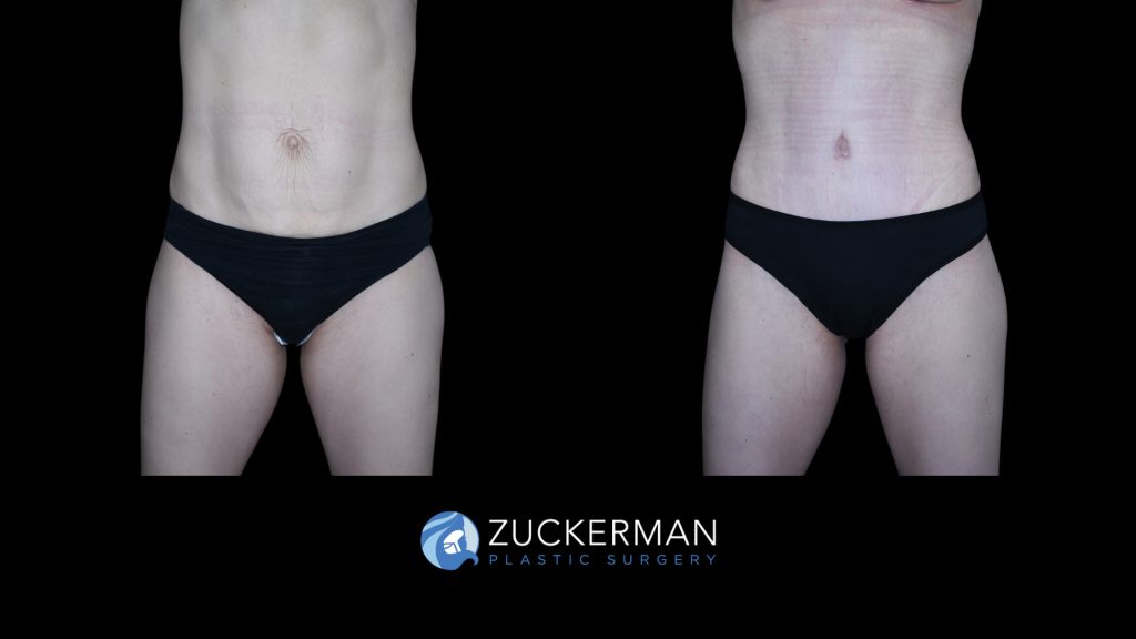 Patient before and after Tummy Tuck | Zuckerman Plastic Surgery