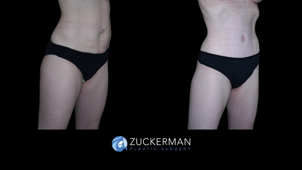 Patient before and after Tummy Tuck | Zuckerman Plastic Surgery