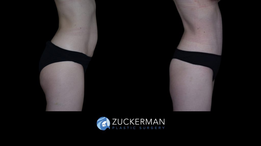 Patient before and after Tummy Tuck | Zuckerman Plastic Surgery