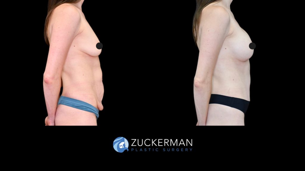 Patient before and after Mommy makeover, Breast Aug & Tummy Tuck | Zuckerman Plastic Surgery