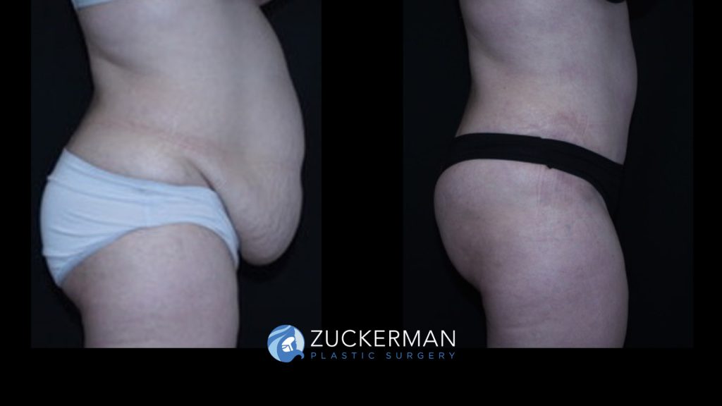 Patient before and after Tummy Tuck | Zuckerman Plastic Surgery