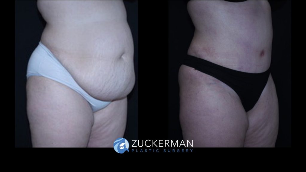 Patient before and after Tummy Tuck | Zuckerman Plastic Surgery