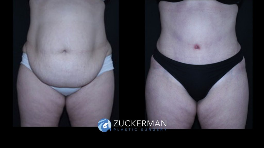 Patient before and after Tummy Tuck | Zuckerman Plastic Surgery