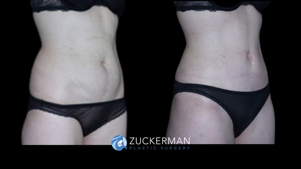 Patient before and after Tummy Tuck | Zuckerman Plastic Surgery