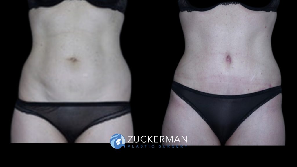 Patient before and after Tummy Tuck | Zuckerman Plastic Surgery