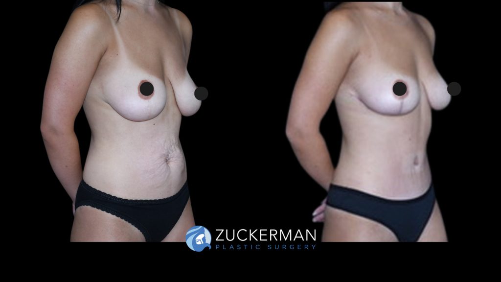 Patient before and after Mommy Makeover, Tummy Tuck and Mastopexy | Zuckerman Plastic Surgery