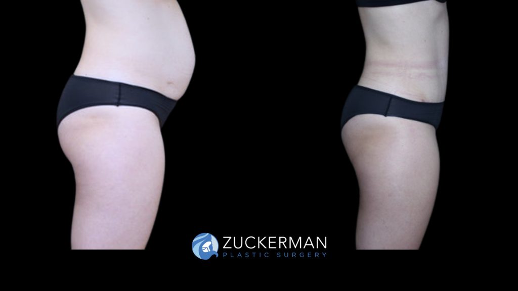 Patient before and after Tummy Tuck | Zuckerman Plastic Surgery