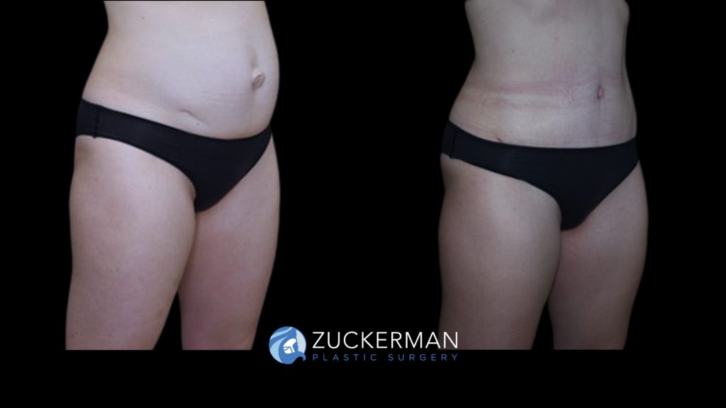 Patient before and after Tummy Tuck | Zuckerman Plastic Surgery