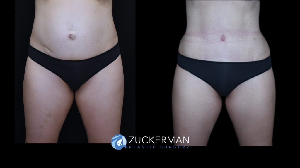 Patient before and after Tummy Tuck | Zuckerman Plastic Surgery