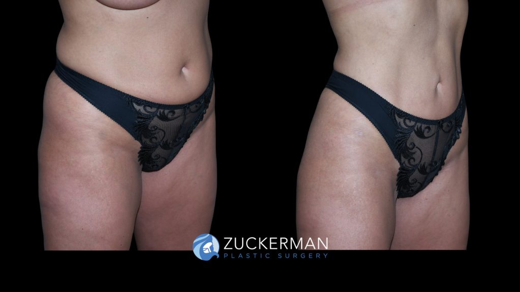 Patient before and after Lipo 360, Liposuction of Abdomen, Flanks, & Lower Back | Zuckerman Plastic Surgery