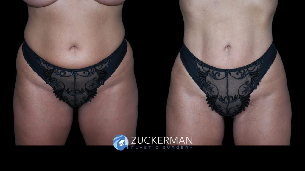 Patient before and after Lipo 360, Liposuction of Abdomen, Flanks, & Lower Back | Zuckerman Plastic Surgery