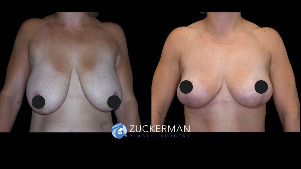 Patient before and after Breast Lift | Zuckerman Plastic Surgery