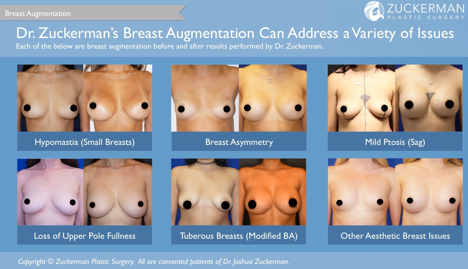 Dr. Zuckerman can address several aesthetic issues of the breasts via breast augmentation surgery as demonstrated by this collection of his before and afters.