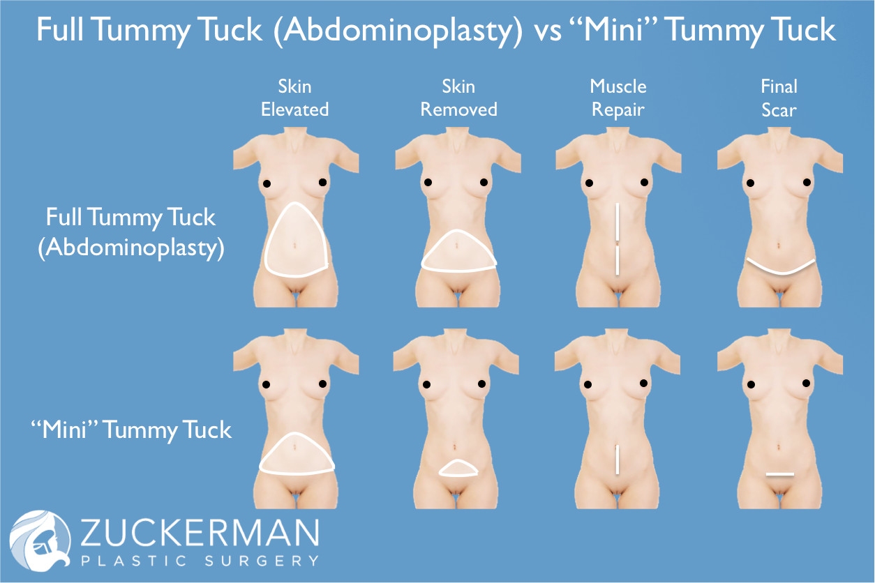 full tummy tuck versus mini 1254x836