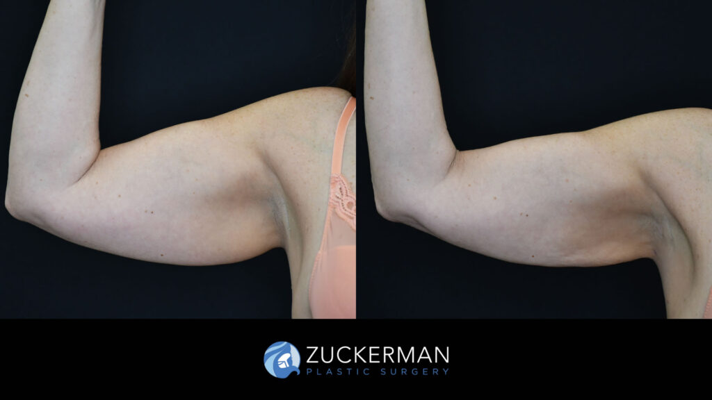 Before and after Liposuction (Armi Lift) by Dr. Zuckerman.