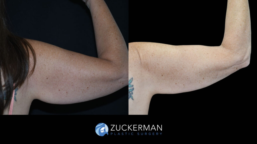 Before and after Liposuction (Armi Lift) by Dr. Zuckerman.