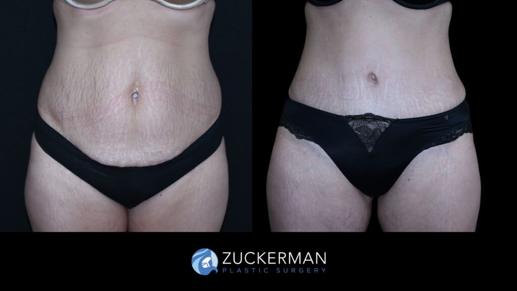 Patient before and after Tummy Tuck | Zuckerman Plastic Surgery