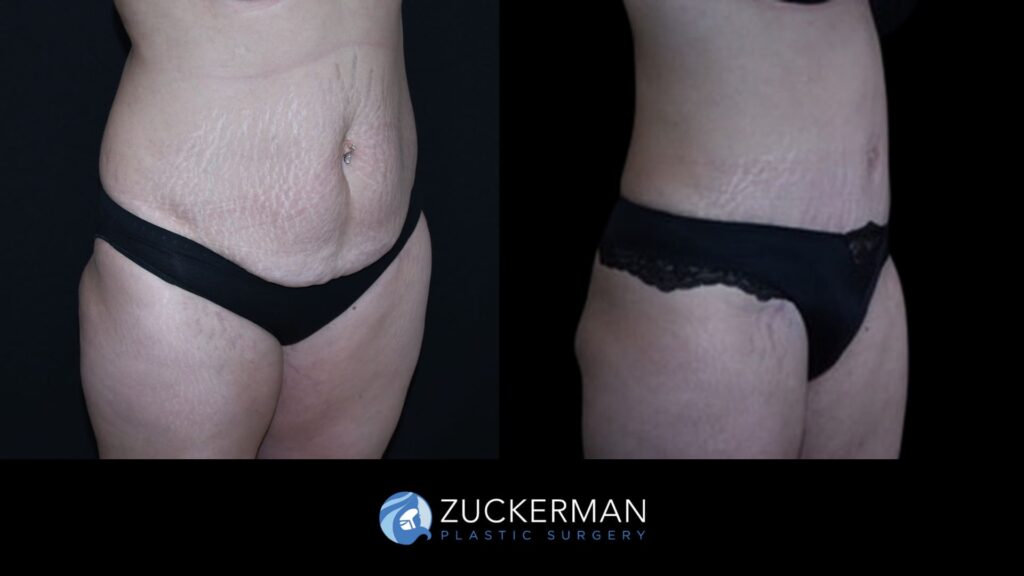 Patient before and after Tummy Tuck | Zuckerman Plastic Surgery