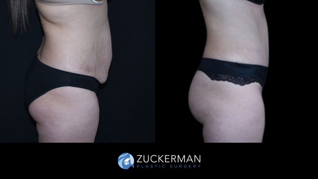 Patient before and after Tummy Tuck | Zuckerman Plastic Surgery