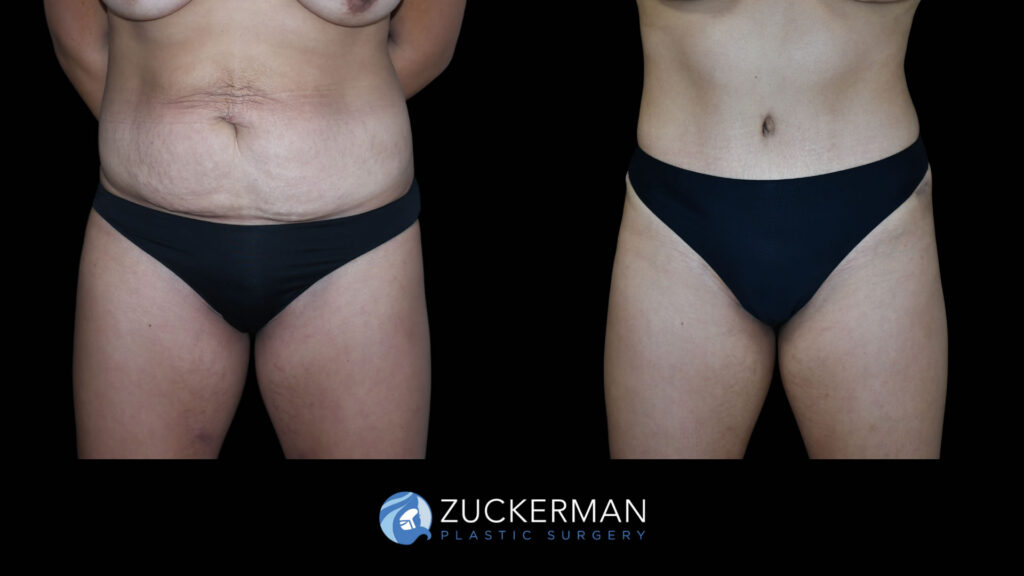 Patient before and after Tummy Tuck by Dr. Zuckerman.