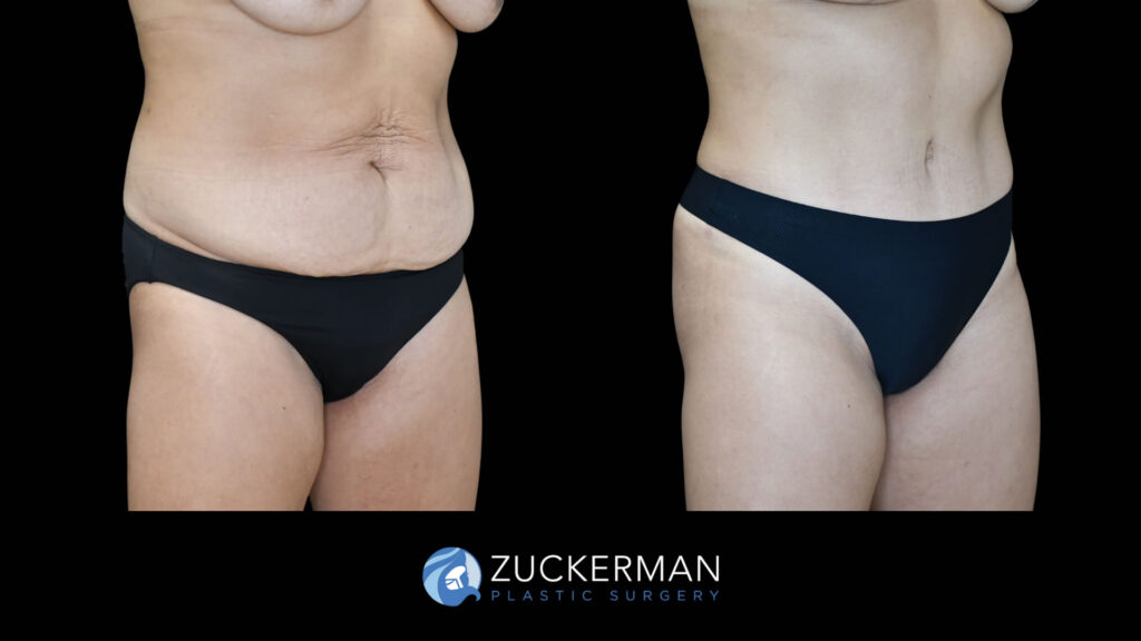 Patient before and after Tummy Tuck by Dr. Zuckerman.