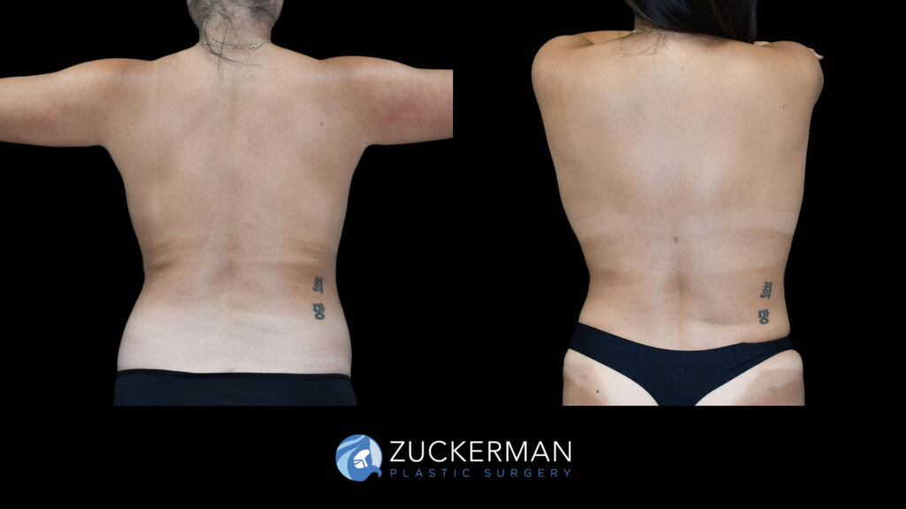 Patient before and after Liposuction by Dr. Zuckerman.