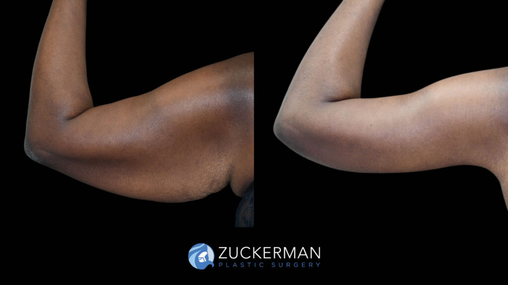 Before and after Brachiplasty by Dr. Zuckerman.