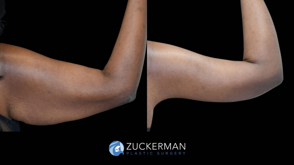 Before and after Brachiplasty by Dr. Zuckerman.