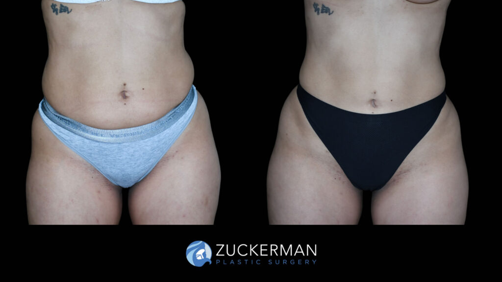 Patient before and after Liposuction by Dr. Zuckerman.