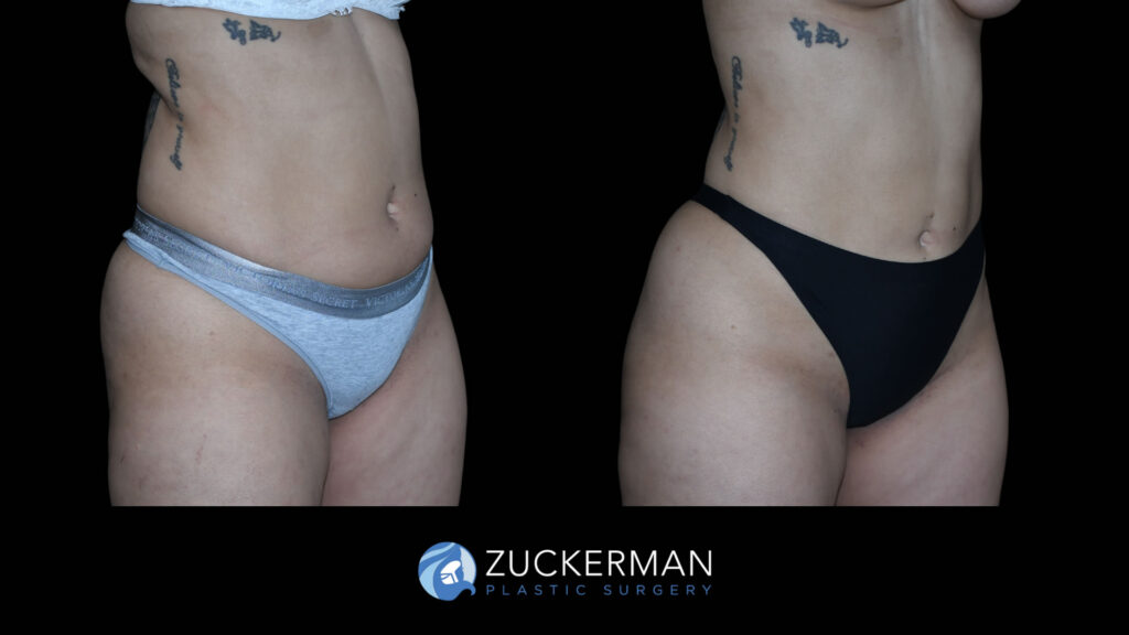 Patient before and after Liposuction by Dr. Zuckerman.
