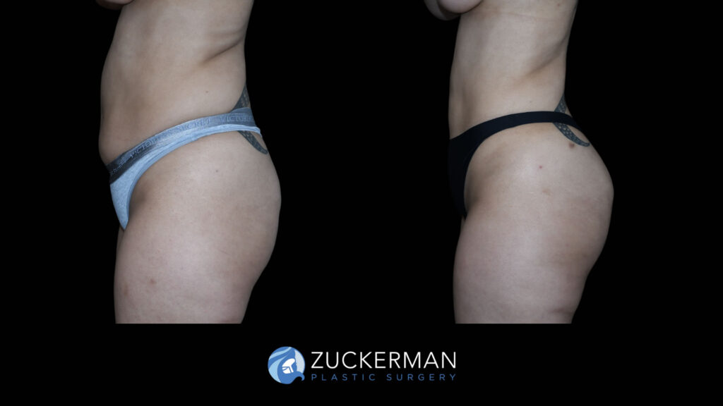 Patient before and after Lipo 360 and BBL by Dr. Zuckerman.