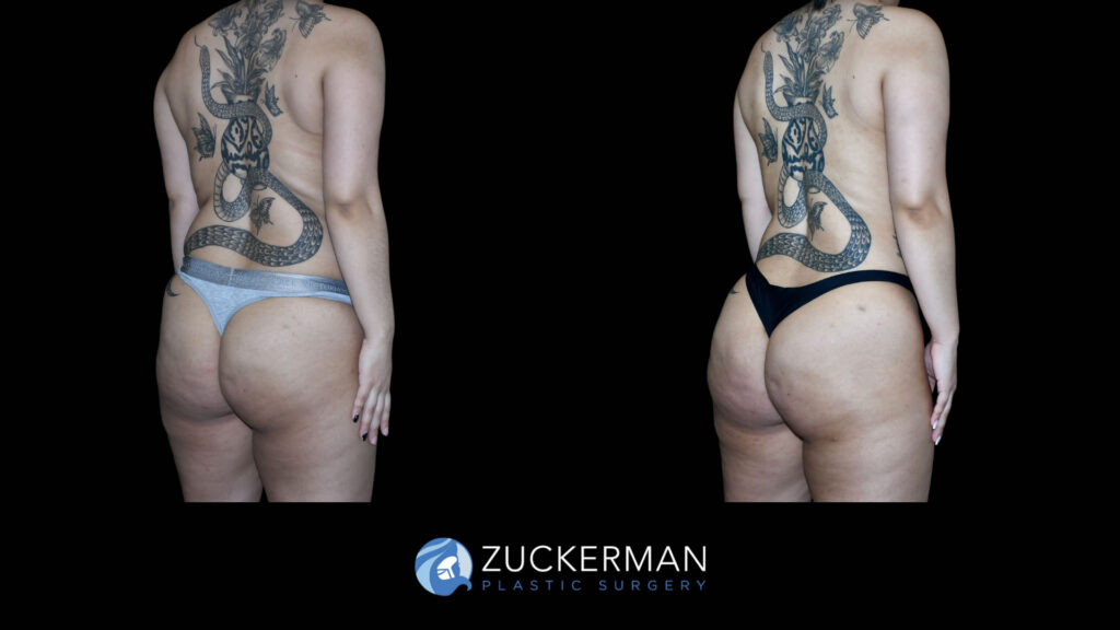 Patient before and after Lipo 360 and BBL by Dr. Zuckerman.