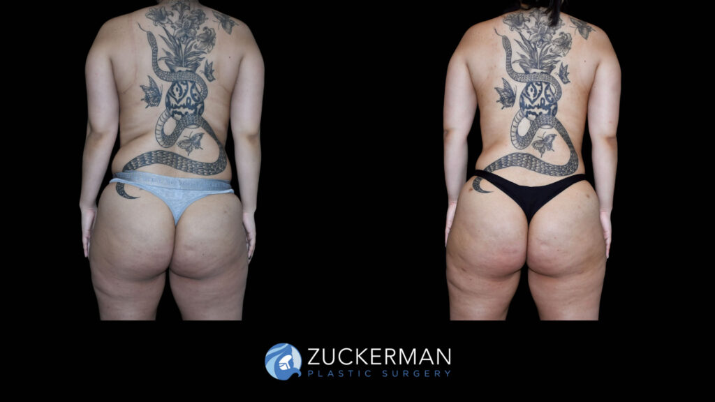 Patient before and after Lipo 360 and BBL by Dr. Zuckerman.
