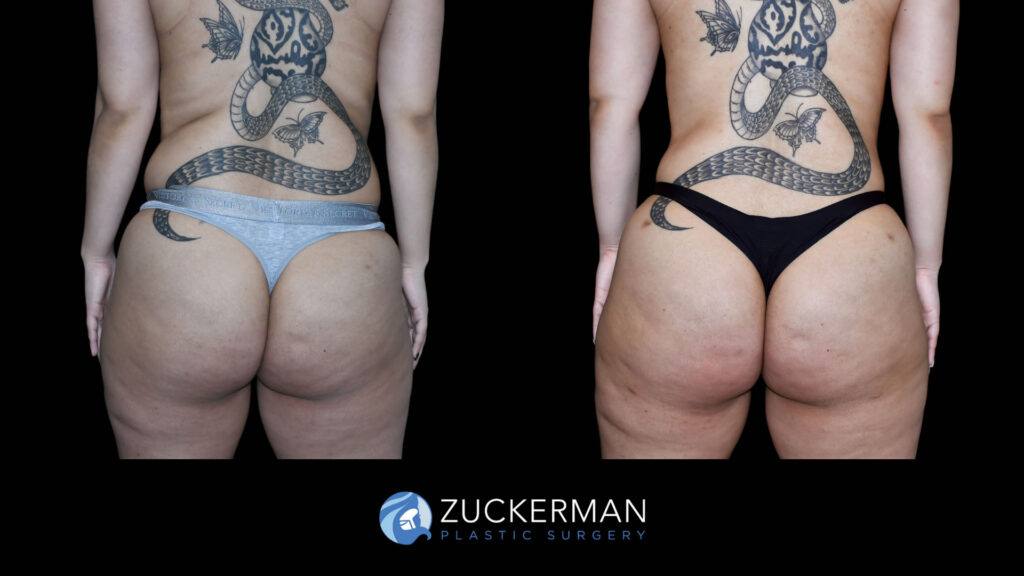 Patient before and after Lipo 360 and BBL by Dr. Zuckerman.
