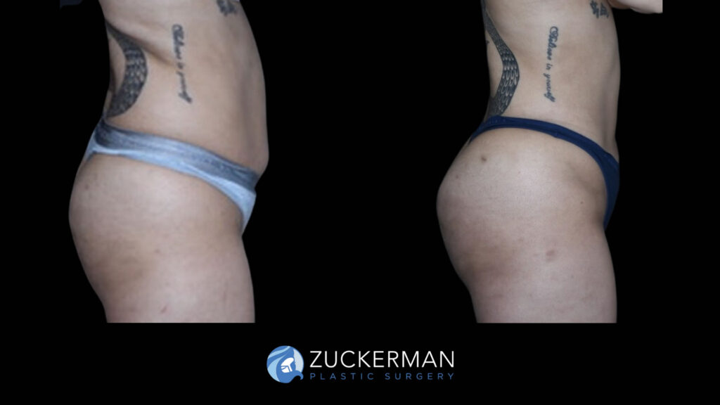 Patient before and after Lipo 360 and BBL by Dr. Zuckerman.