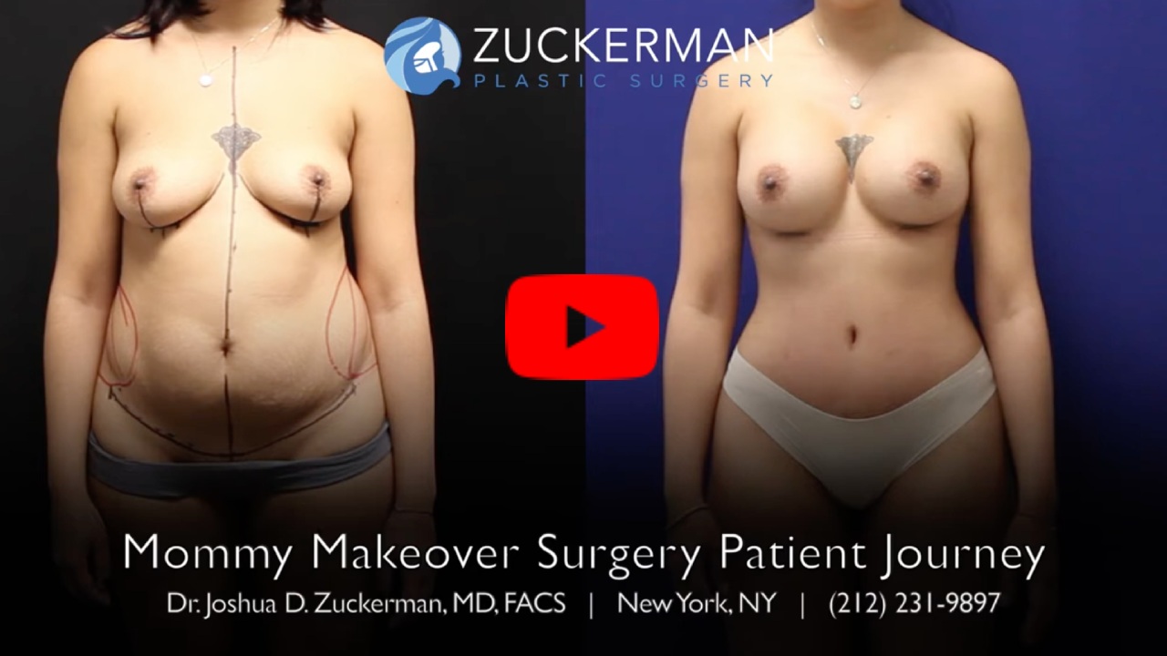 Thumbnail of YouTube video 'Mommy Makeover Surgery Patient Journey - Zuckerman Plastic Surgery' with play button
