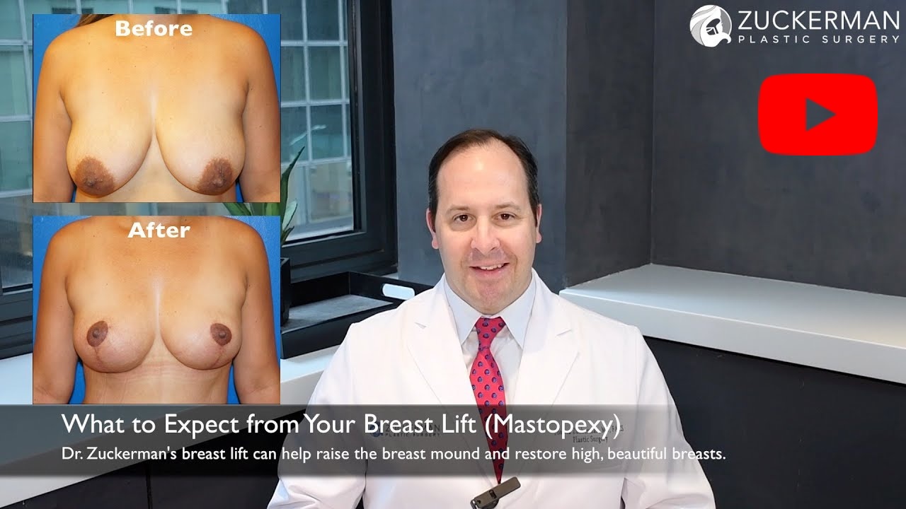 Thumbnail of YouTube video 'What to Expect from Your Breast Lift (Mastopexy) - Dr. Joshua D. Zuckerman, MD, FACS' with play button