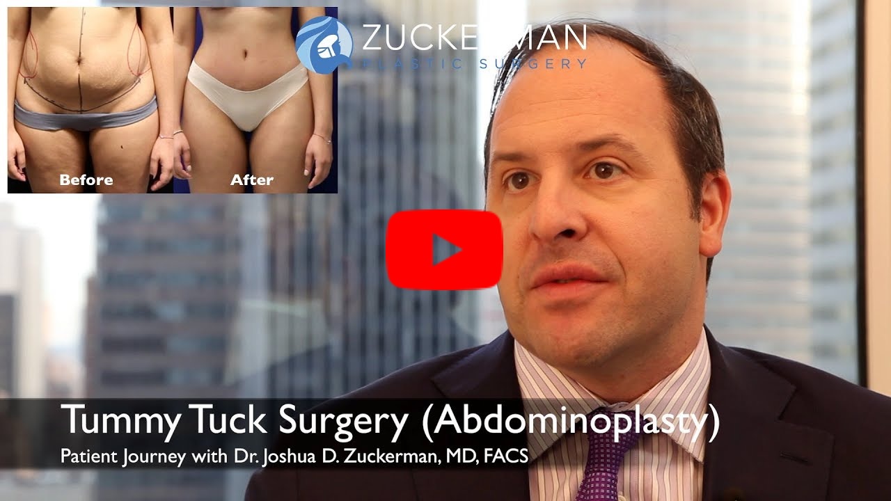 Thumbnail of YouTube video 'Tummy Tuck Surgery (Abdominoplasty) Patient Journey - Zuckerman Plastic Surgery' with play button