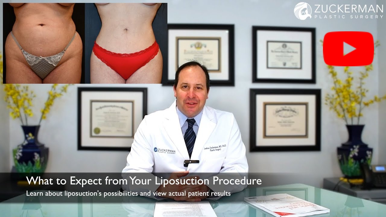 Thumbnail of YouTube video 'What to Expect from Your Liposuction Procedure' with play button