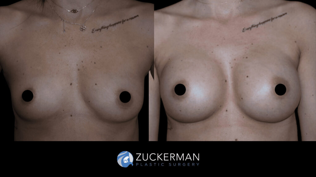 Patient before and after Breast Augmentation | Zuckerman Plastic Surgery