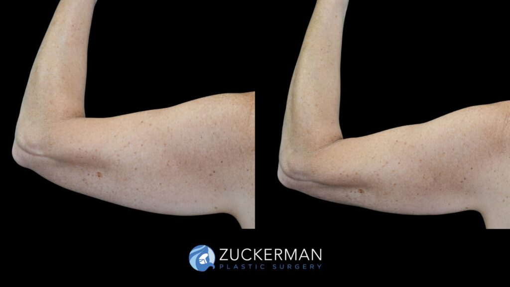 Before and after Liposuction (Armi Lift) by Dr. Zuckerman.